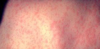Инфекция морбили/дребна шарка. Снимка: wikimedia commons