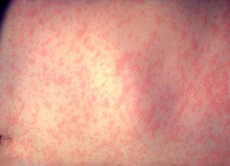 Инфекция морбили/дребна шарка. Снимка: wikimedia commons