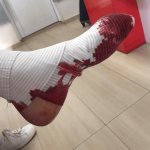 Кървящ крак