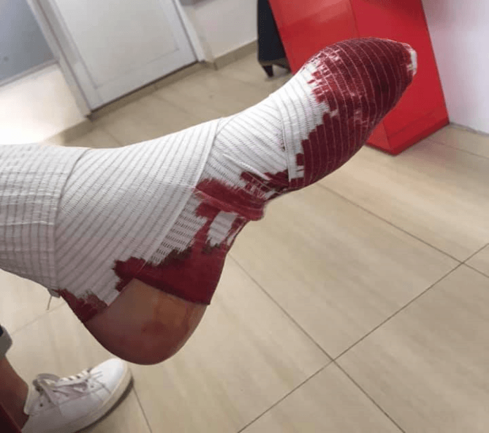 Кървящ крак