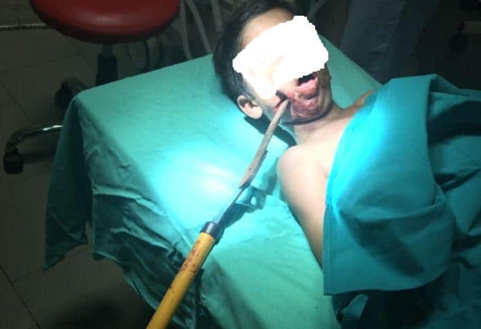 Дете с ножица в главата