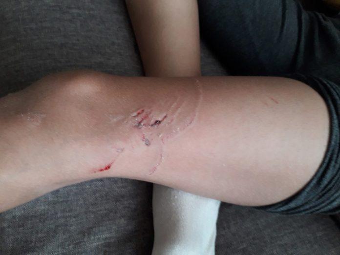 Нападнато дете