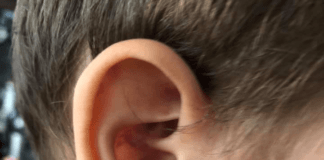 Насинено ухо