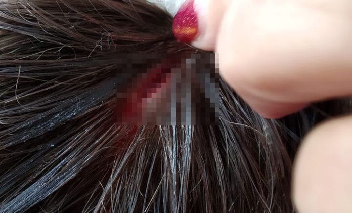 Раната. Снимка: Фейсбук, Nadya Bulatova‎