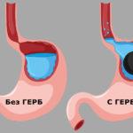 Какво е гастроезофагеална рефлуксна болест (ГЕРБ)?