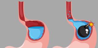 Какво е гастроезофагеална рефлуксна болест (ГЕРБ)?