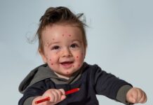 Дете, варицела