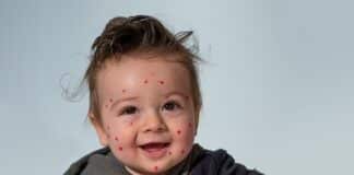 Дете, варицела