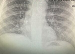 Зъб, УМБАЛ-Бургас