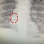 Зъб, УМБАЛ-Бургас