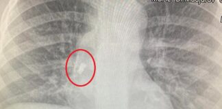 Зъб, УМБАЛ-Бургас