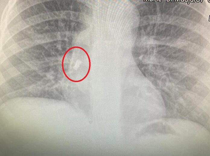 Зъб, УМБАЛ-Бургас