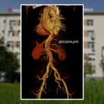 Разкъсана аорта