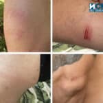 Наранявания