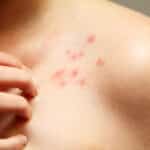 Ужилване, алергия