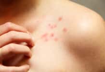 Ужилване, алергия