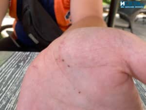 Наранена ръка