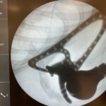 3D принтирана ендопротеза