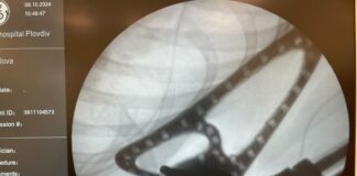 3D принтирана ендопротеза