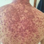 Рядък случай в УМБАЛ-Бургас