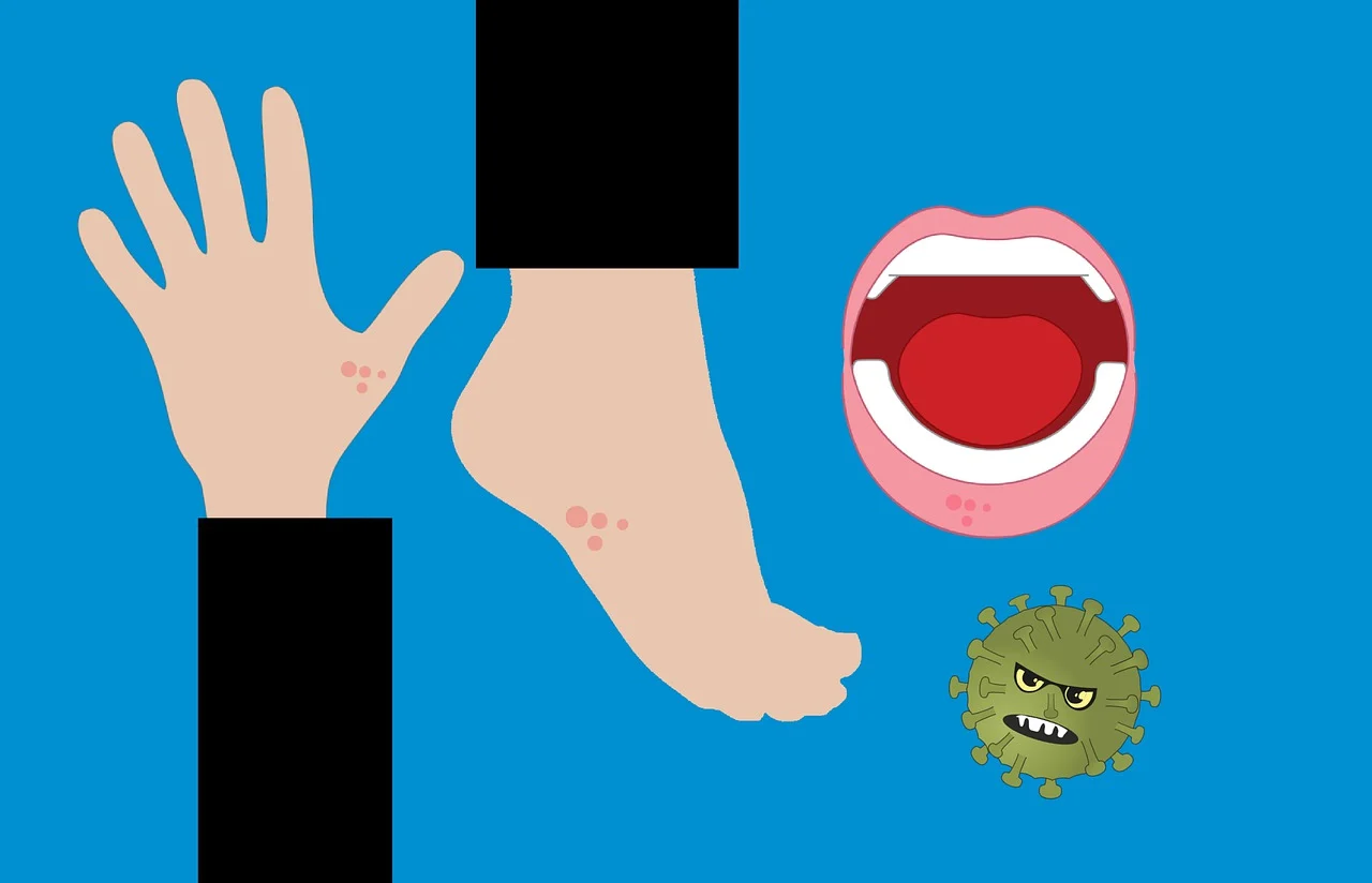 Коксаки вирусът известен още като синдром ръка крак уста е често срещана