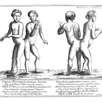 Сиямски близнаци