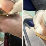 Обездвижване на крака на дете в Разлог