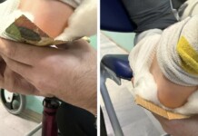 Обездвижване на крака на дете в Разлог