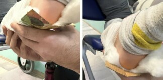 Обездвижване на крака на дете в Разлог