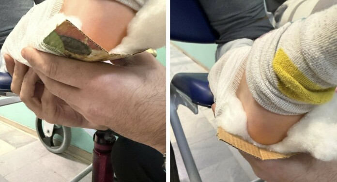 Обездвижване на крака на дете в Разлог